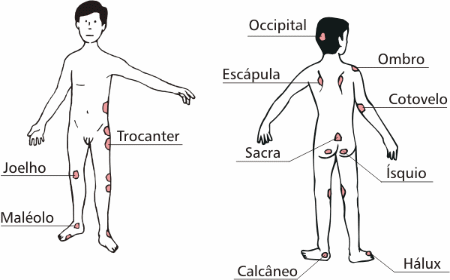Figura 3 - Mapa topográfico - Úlceras de pressão. Figura 3 - Mapa topográfico - Úlceras de pressão.