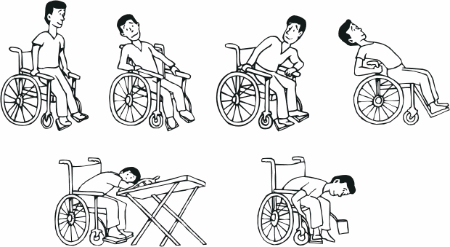 Figura 4 - Aliviando pontos de pressão. Figura 4 - Aliviando pontos de pressão.