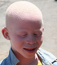 Menino albino.