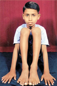 Foto de um menino com a síndrome de Smith-Lemli-Opitz.